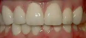 Close-up of healthy front teeth and gums