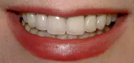 Close-up of smiling mouth with white teeth