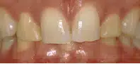 Close-up of upper front teeth with gap