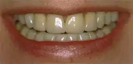 Close-up smile showing slightly yellow teeth